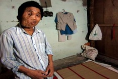 Misfortunes of man with facial deformities