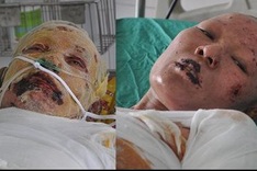 Dao burn victims need urgent help