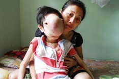 Boy with large facial tumour needs medical treatment