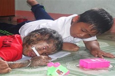 DTiNews readers support little girl with serious skin disease