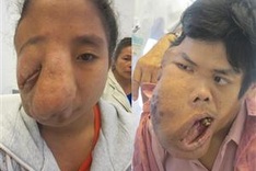 US surgeon successfully removes giant face tumours
