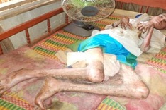 Khmer man bedridden for years due to deformed limbs