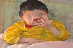 Eight-year old boy with facial deformity