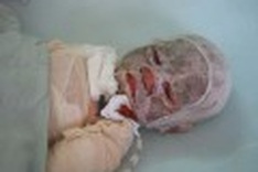 Baby burn victim is improving