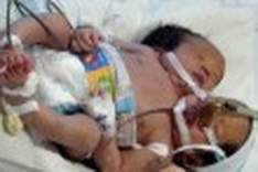 Twins malformed, hard to separate: doctors
