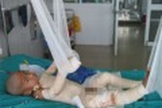 3 year old suffers horrific burns