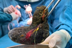Doctors remove large hairball from seven-year-old girl