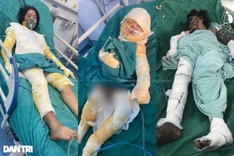 Bac Ninh man needs help to save family from serious burns