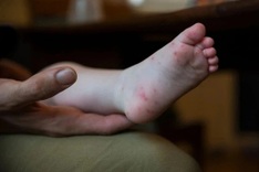 Dengue and hand, foot, and mouth disease surge in HCM City