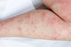HCM City sees spike in skin disease cases after prolonged rainfall