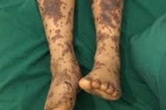 Hue sees 12 Streptococcus suis cases in two weeks, one dead