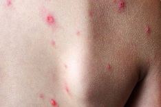 Dong Nai records first monkeypox cases this year