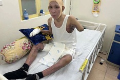 Young man with severe burns receives USD 22,600 in support for treatment