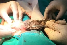 Doctors remove 20cm hairball from four-year-old girl's stomach