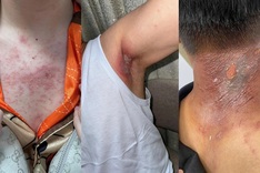 Hanoi doctors warn of skin damage from rove beetles