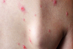 Ho Chi Minh City records first monkeypox case of 2026