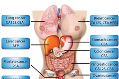 Dấu ấn ung thư là gì?