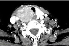 Khàn tiếng kéo dài, coi chừng ung thư tuyến giáp