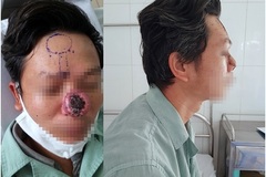 Tái tạo mũi mới cho người đàn ông bị khối u ung thư “ăn” mất mũi