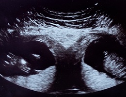 Người phụ nữ mang song thai ở 2 tử cung