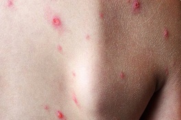 Dong Nai records first monkeypox cases this year