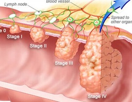 Xét nghiệm có máu trong phân cảnh báo ung thư đại trực tràng?