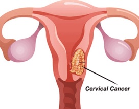 Xét nghiệm tế bào học âm đạo tầm soát ung thư cổ tử cung là gì?