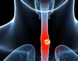 Bị ung thư thực quản nhiều nguy cơ mắc thêm ung thư thứ 2