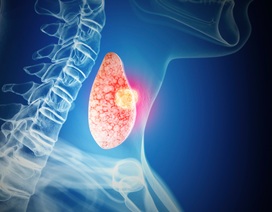 Bệnh nhân ung thư tuyến giáp phải làm gì khi kết thúc điều trị?