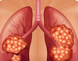 Tưởng lưỡi đen do hút thuốc hóa ung thư phổi