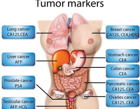 Dấu ấn ung thư là gì?