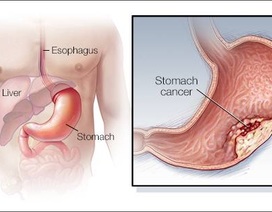 Những ai cần đề phòng bệnh ung thư dạ dày “gõ cửa”