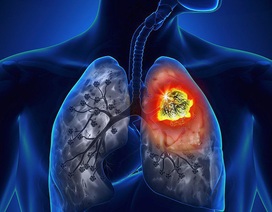 Ung thư phổi - Những con số đáng báo động