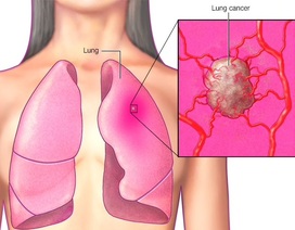 Bệnh nhân ung thư phổi sống được bao lâu?