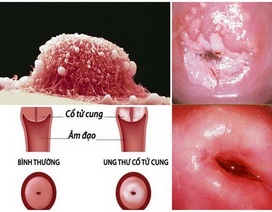 Lây nhiễm HPV và nguy cơ ung thư cổ tử cung