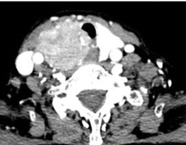 Khàn tiếng kéo dài, coi chừng ung thư tuyến giáp