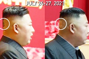 Băng dán y tế trên đầu ông Kim Jong-un gây chú ý