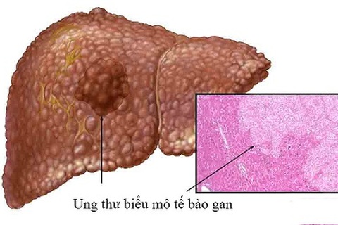 Liệu pháp mới giúp kéo dài cuộc sống cho bệnh nhân ung thư gan giai đoạn muộn