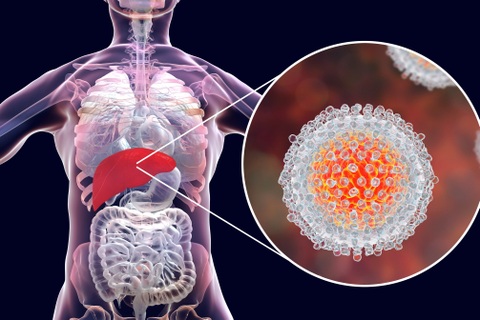 Viêm gan C: Khó phát hiện sớm, có thể đe dọa đến tính mạng