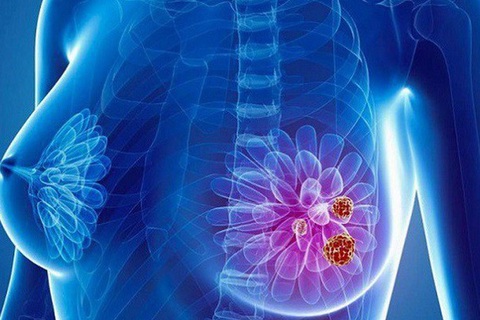 Ung thư vú: Mang gen này chị em có thể không cần hóa trị sau phẫu thuật