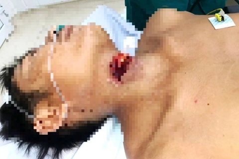 Cấp cứu kịp thời một trường hợp cắt đứt cổ tự tử