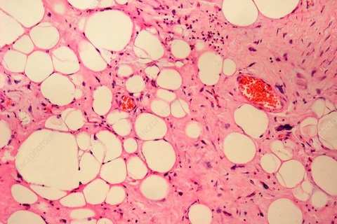 Ung thư mô liên kết: Dấu hiệu nhận biết và cách điều trị