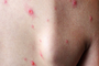 Ho Chi Minh City records first monkeypox case of 2026