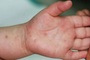 HCM City records over 40,000 hand, foot and mouth disease cases