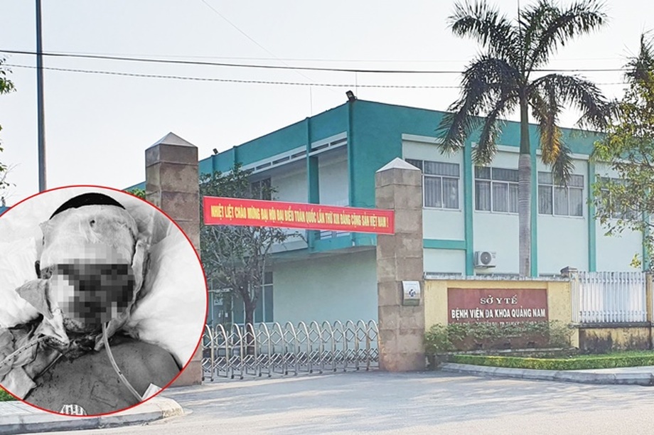 Lên cơn co giật, người phụ nữ bị bỏng nặng do ngã vào bếp lửa